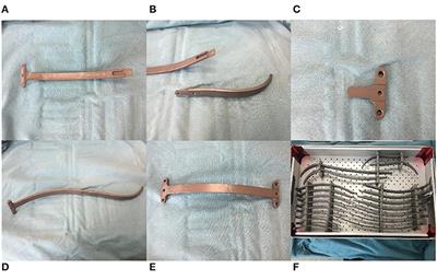 A Modfied Nuss Procedure for Recurrent Pectus Excavatum of Adults